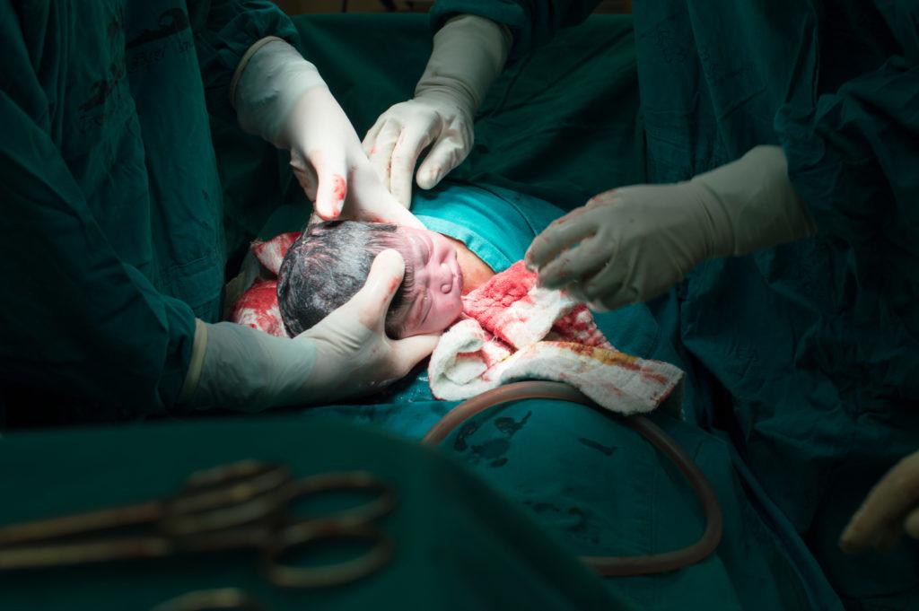 c-section