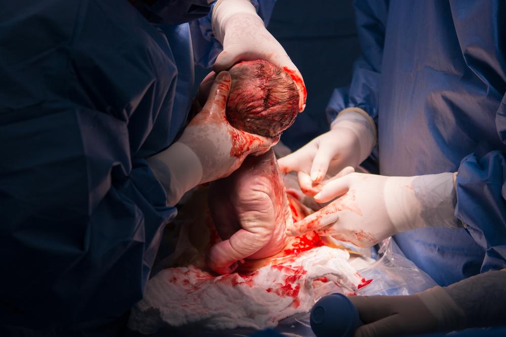 having a c-section
