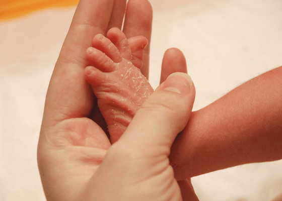 newborn with peeling skin
