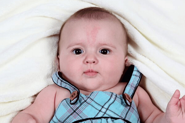 Baby with birthmark on forehead